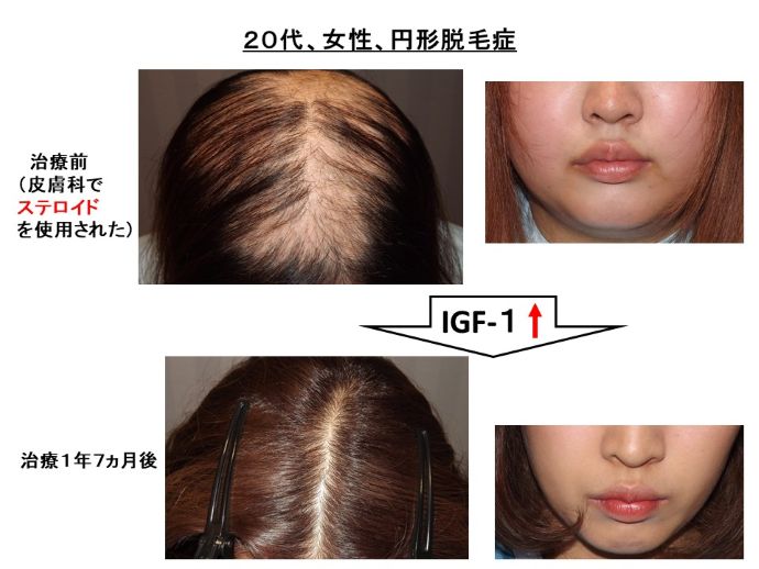 円形脱毛症　病院